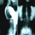 Full Spine Radiographs