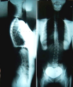 Full Spine Radiographs
