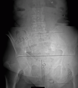 Sacral Fracture_Gnote 12-10_1