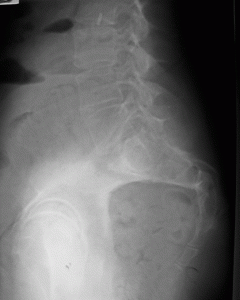 Sacral Fracture_Gnote 12-10_2