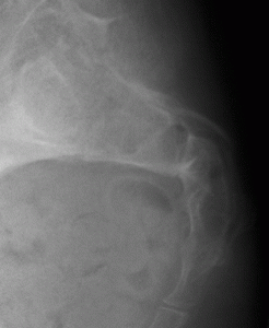 Sacral Fracture_Gnote 12-10_3